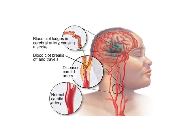 Brain Hemorrhage Treatment