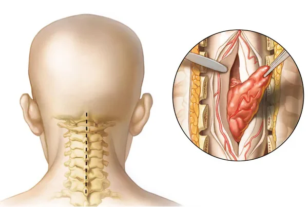 Brain and Spine Tumor Surgery